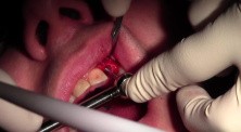 Narrow Platform Osseotite Implant Placement Into Mineross Regenerated Bone