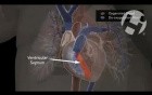 Normal Newborn Circulation