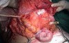 Metastasis of Renal Carcinoma to the ascending colon (6 of 11)