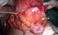 Metastasis of Renal Carcinoma to the ascending colon (6 of 11)