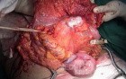Metastasis of Renal Carcinoma to the ascending colon (6 of 11)