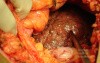 Macronodular Cirrhosi (2 of 2)