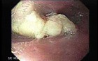 Esophageal Squamous Cell Carcinoma of the the Upper Third of the Esophagus that Invaded the Subglottis - 75 Years-Old Woman