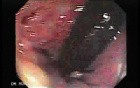 Endoscopic Resection of Giant Tubulo-Villous of the rectum (30 of 35)