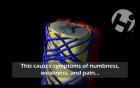 Epidural Hematoma