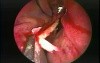 Nasal Septoplasty - Endoscopy