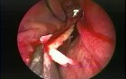 Nasal Septoplasty - Endoscopy