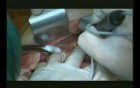 Right Open Hemicolectomy – Technical Principles - Part 1