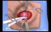 Inguinal Hernia Surgery 3D Medical Animation - Open Procedure