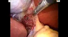 Single Incision Laparoscopic Cholecystectomy