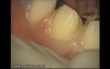 Final Preparation For Aesthetic Veneers (1/4)