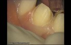 Final Preparation For Aesthetic Veneers (1/4)