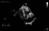 Cardiac Tamponade
