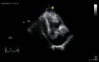Cardiac Tamponade