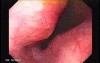 Gastrointestinal Stromal Tumors - Closer Look at the Tumor