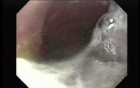 Achalasia - residual food (4 of 11)