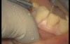 Upper Arch Teeth Preparation And Provisional Crowns (1/5)