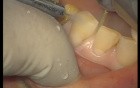 Upper Arch Teeth Preparation And Provisional Crowns (1/5)