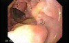 Gastroduodenal MALT lymphoma (7 of 9)