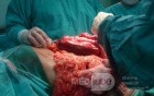 Mesenteric Ischemia (9 of 12)