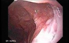 Hiatus Hernia (2 of 3)