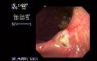 Gastric Cancer - Endoscopy
