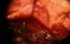 Brain tumor Surgery Footage
