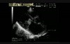 Infective Endocarditis: Vegetation On Both Mitral Leaflets With Involvement Of Aortic Cusps