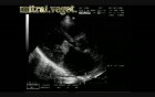 Infective Endocarditis: Vegetation On Both Mitral Leaflets With Involvement Of Aortic Cusps