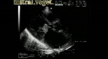 Infective Endocarditis: Vegetation On Both Mitral Leaflets With Involvement Of Aortic Cusps