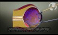 Vitrectomy