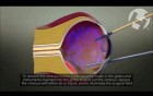Vitrectomy