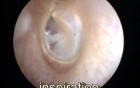 Roving anterosuperoior segment movement of the left eardrum