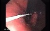 Esophageal Candidiasis Infected with Bacteria - Retroflexed View of Tiny Lesions