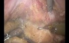 Concomitant Prostata Cancer - Robotic TME Excision