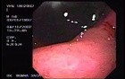Zollinger- Ellison Syndrome - Gastric Ulcer with Gastrocolic Fistula (1 of 21)