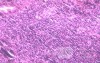 Lymphoma B small cells of the Jejuno (7 of 10)