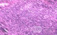 Lymphoma B small cells of the Jejuno (7 of 10)