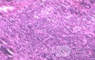 Lymphoma B small cells of the Jejuno (7 of 10)