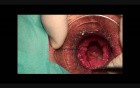 Stapled Haemorrhoidopexy