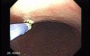 Multiple Gastric Angiodysplasia (6 of 17)