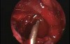 Caldwell Luc Procedure - Endoscopy