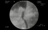 Ureteral access after a surgicaly induced injury