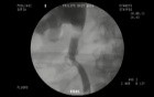 Ureteral access after a surgicaly induced injury