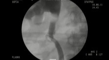 Ureteral access after a surgicaly induced injury