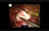 Robotic Myomectomy