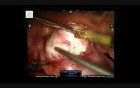 Robotic Myomectomy