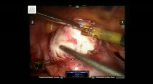 Robotic Myomectomy
