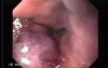 Long Standing Alcohol Abuse - Follow Up After Ligation