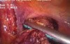Laparoscopic colon resection